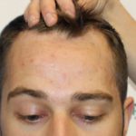 HHC Hair Loss Clinic - Hair Transplant