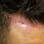 FUE Hair Transplant - Patient 1 - Immediately After Procedure