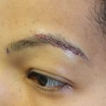 FUE Eyebrow Transplant - Patient 10 - Immediately After Procedure