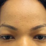 FUE Eyebrow Transplant - Patient 10 - Before Procedure