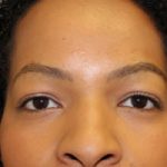 FUE Eyebrow Transplant - Patient 10 - After Procedure