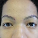FUE Eyebrow Transplant - Patient 10 - Immediately After Procedure