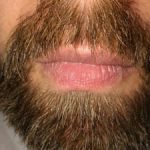FUE Beard Transplant - Patient 11 - 3 Months After Procedure