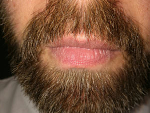 FUE Beard Transplant - Patient 11 - 3 Months After Procedure