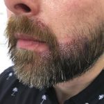 FUE Beard Transplant - Patient 11 - Immediately After Procedure