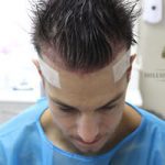 FUE Hair Transplant - Patient 3 - Immediately After Procedure