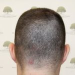 FUE Hair Transplant - Patient 4 - Donor Area Before Procedure