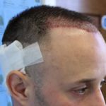 FUE Hair Transplant - Patient 4 - Immediately After Procedure
