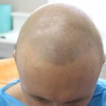FUE Hair Transplant Patient 5 - Before