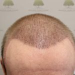 FUE Hair Transplant - Patient 5 - One Month After Procedure