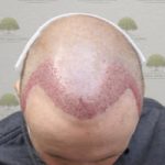 FUE Hair Transplant - Patient 5 - Immediately After Procedure