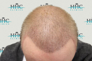 Hair Loss Treatment Results - HHC