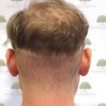 FUE Hair Transplant - Patient 6 - Donor Area Before Procedure