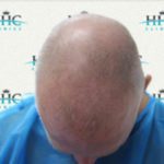 FUE Hair Transplant - Patient 7 -Donor Area before Procedure