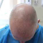 FUE Hair Transplant - Patient 7 - Before