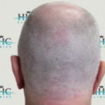 FUE Hair Transplant - Patient 7 - Donor Area before Procedure