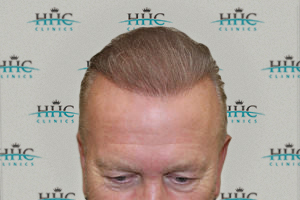 Hair Transplant Example - 4,000 hair grafts | HHC Clinics