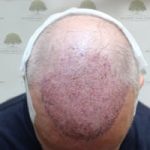 FUE Hair Transplant - Patient 7 - Immediately After Procedure