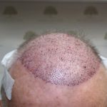 FUE Hair Transplant - Patient 7 - Immediately After Procedure