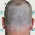 FUE Hair Transplant - Patient 8 - Donor Area Before Procedure