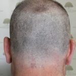 FUE Hair Transplant - Patient 8 - Donor Area Before Procedure