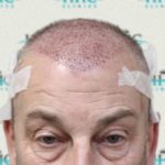 FUE Hair Transplant - Patient 8 - Immediately After Procedure