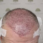 FUE Hair Transplant - Patient 8 - Immediately After Procedure