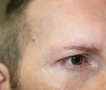 FUE Eyebrow Transplant - Patient 9 - Before Procedure