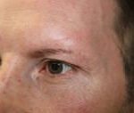 FUE Eyebrow Transplant Patient 9 - Before