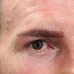 FUE Eyebrow Transplant - Patient 9 - Immediately After Procedure
