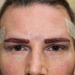 FUE Eyebrow Transplant - Patient 9 - Immediately After Procedure