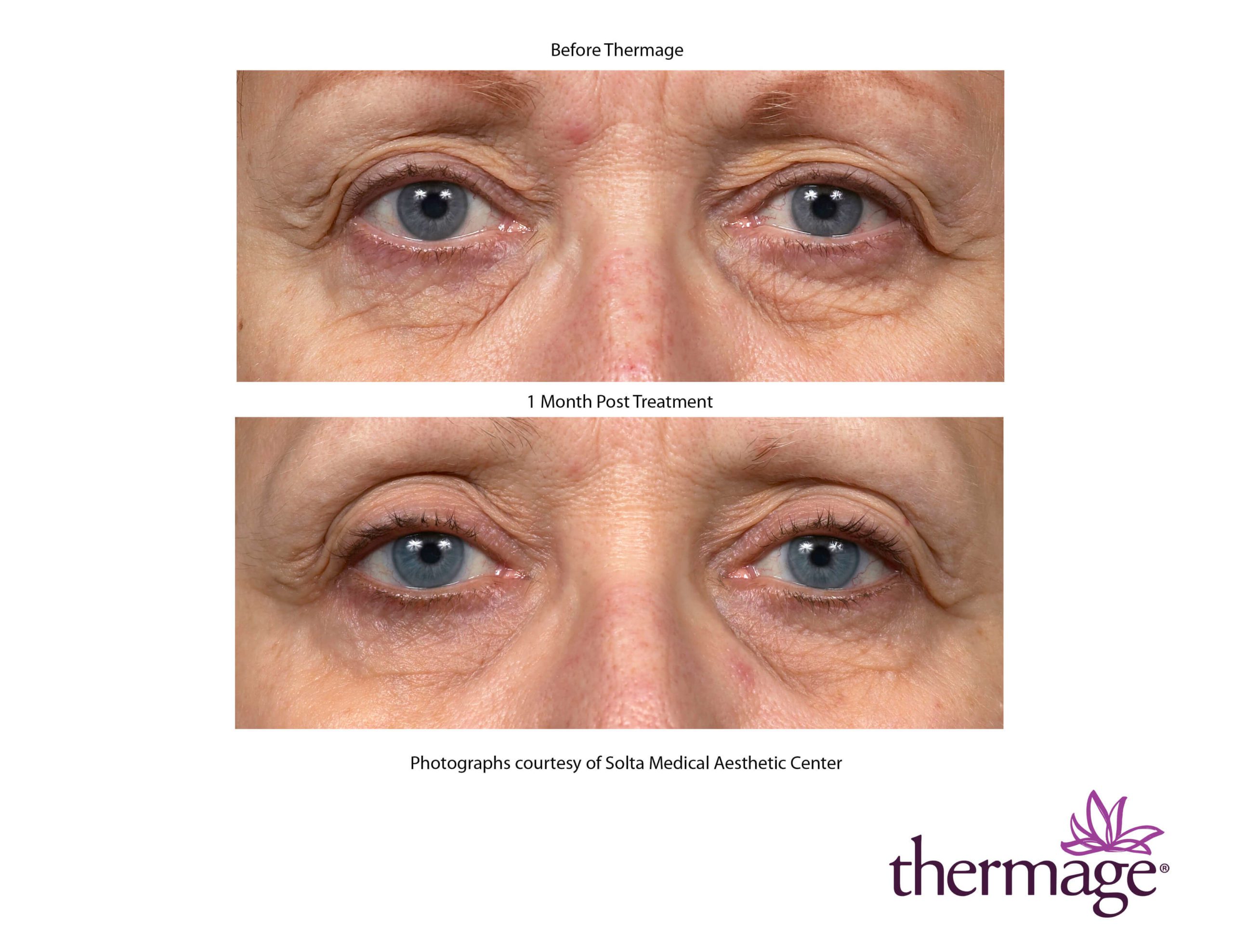 thermage RF therapy