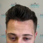 patient 1 6 months after the fue hair transplant procedure