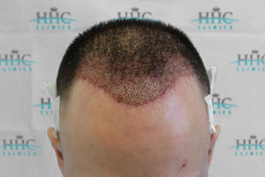 patient 4 hair transplant immediately after