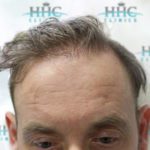 patient 6 for FUE hair transplant before procedure