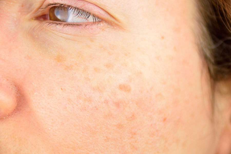 Sun spots treatments and causes